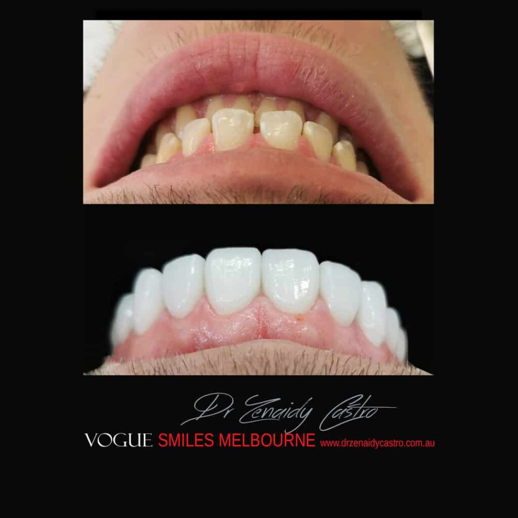 Prepless-No-Grinding-Lumineers-Porcelain-Veneers