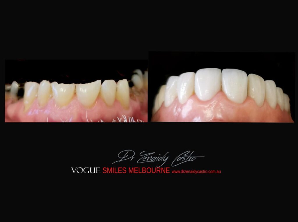Prepless-No-Grinding-Lumineers-Porcelain-Veneers