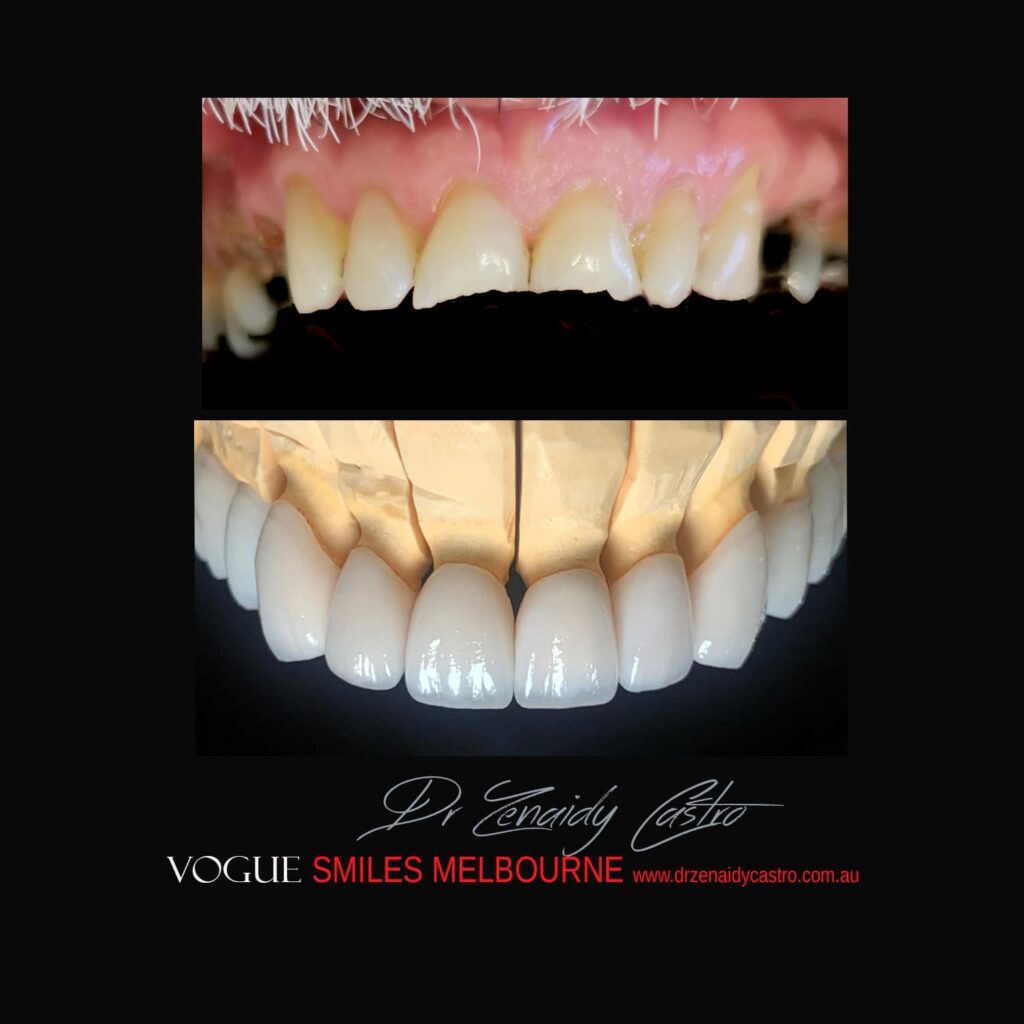 Prepless-No-Grinding-Lumineers-Porcelain-Veneers