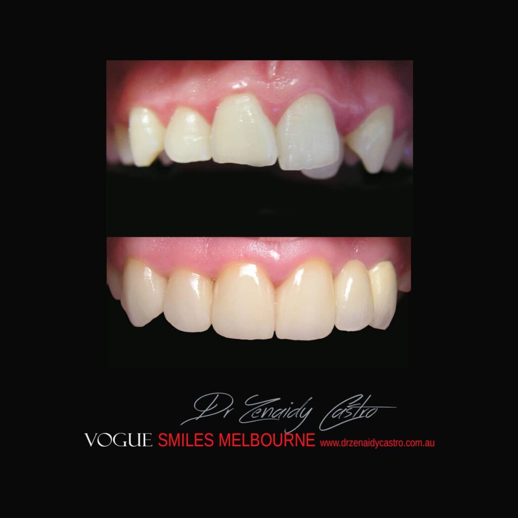 Prepless-No-Grinding-Lumineers-Porcelain-Veneers