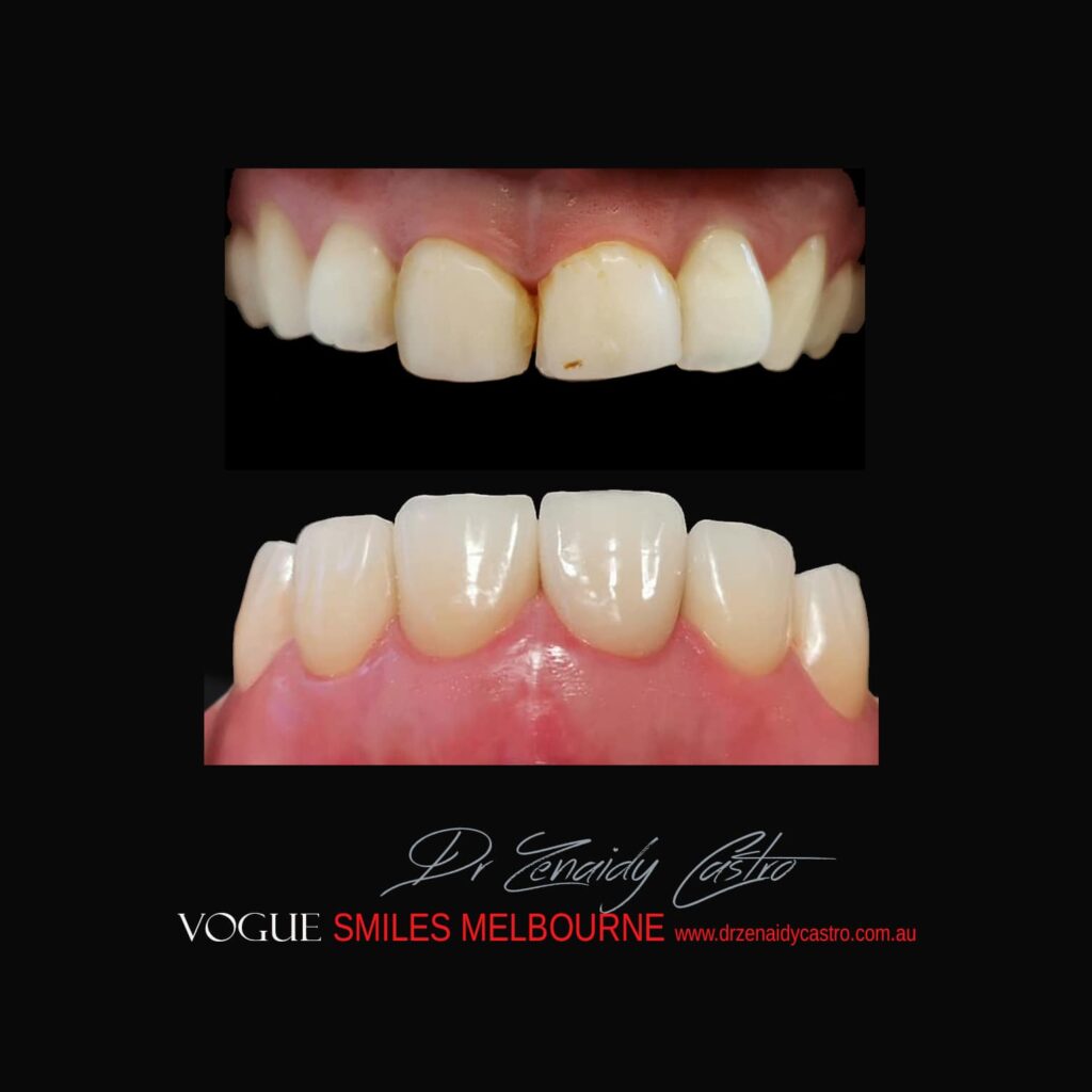 Prepless-No-Grinding-Lumineers-Porcelain-Veneers