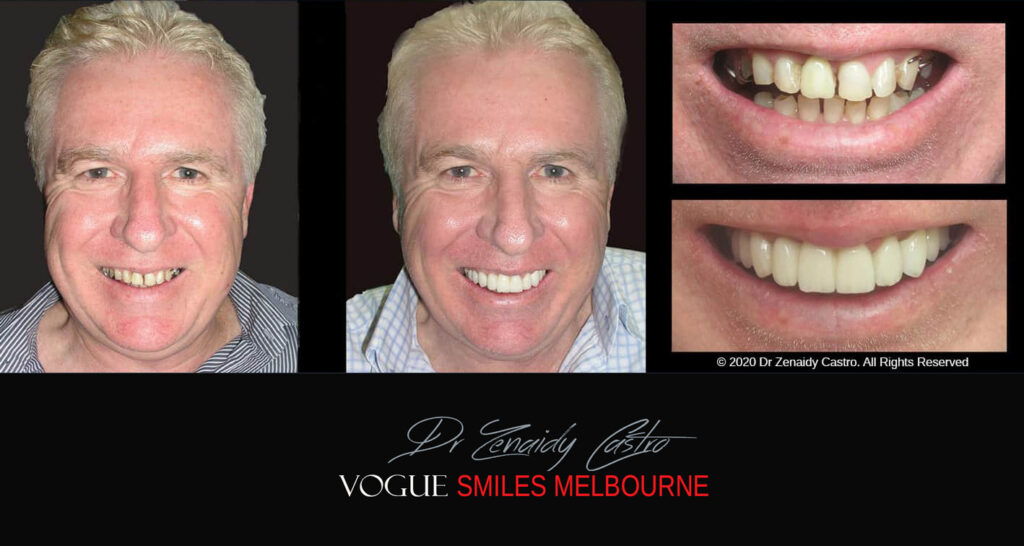Small-Short-Worn-Down-Teeth-Before-and-After-Melbourn