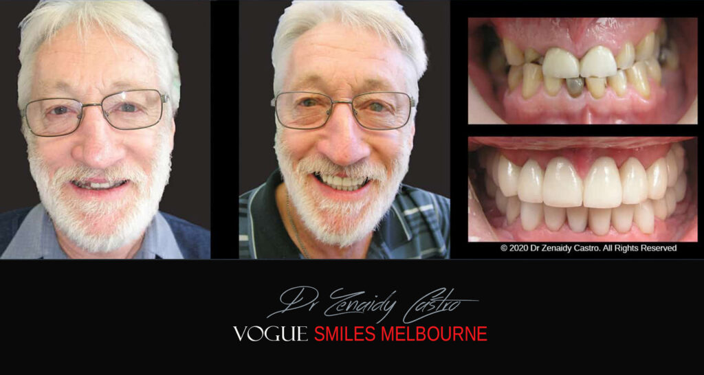 Small-Short-Worn-Down-Teeth-Before-and-After-Melbourn