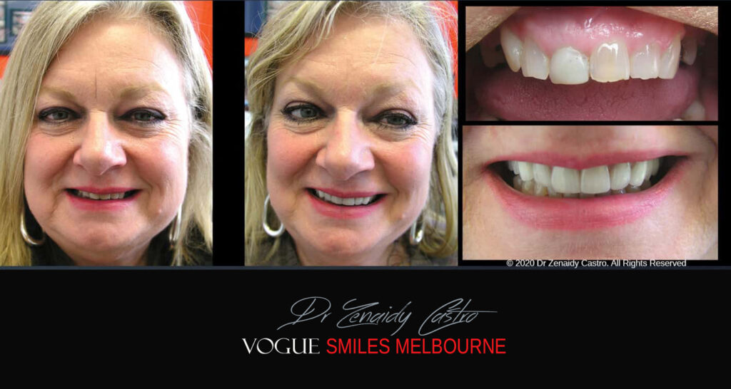 Small-Short-Worn-Down-Teeth-Before-and-After-Melbourn