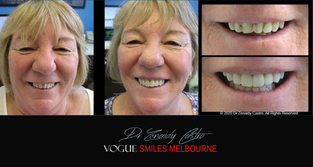 Small-Short-Worn-Down-Teeth-Before-and-After-Melbourn