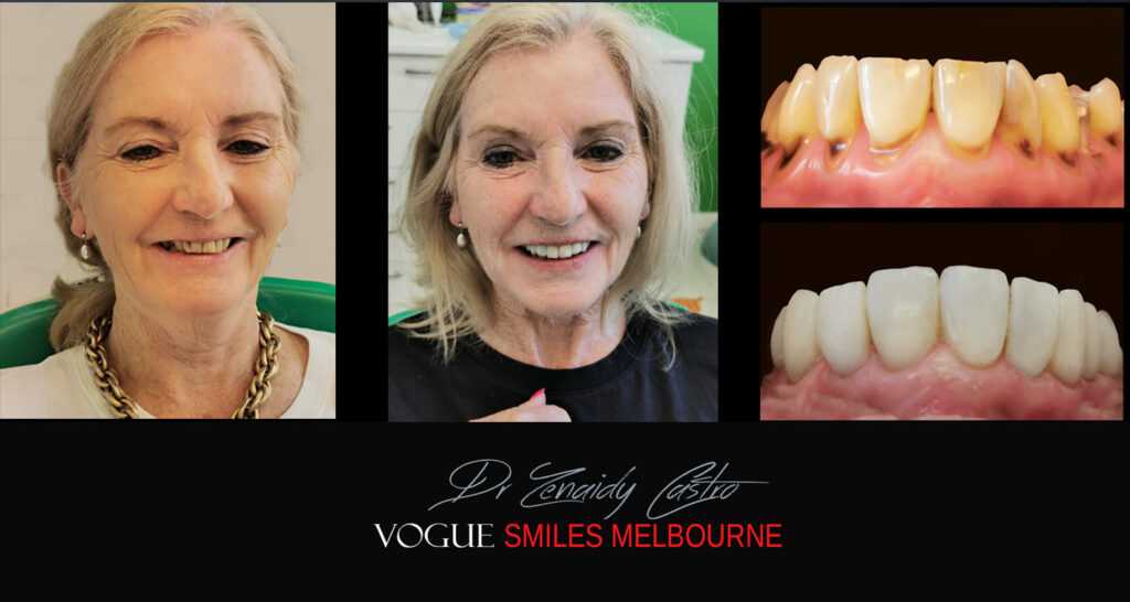 Small-Short-Worn-Down-Teeth-Before-and-After-Melbourn