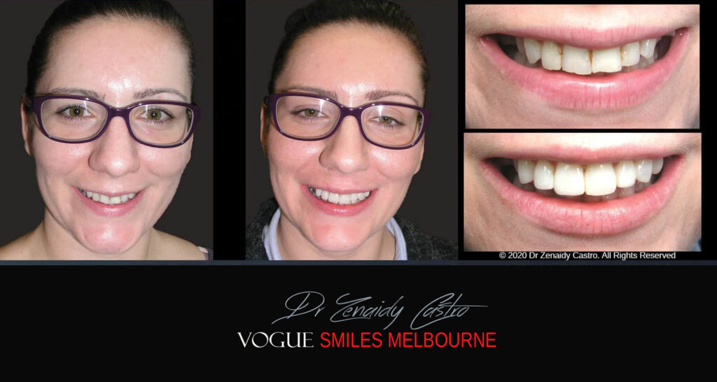 Small-Short-Worn-Down-Teeth-Before-and-After-Melbourn
