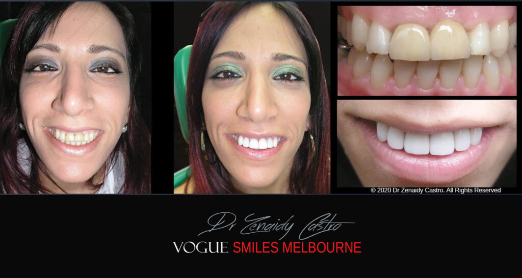 Small-Short-Worn-Down-Teeth-Before-and-After-Melbourne