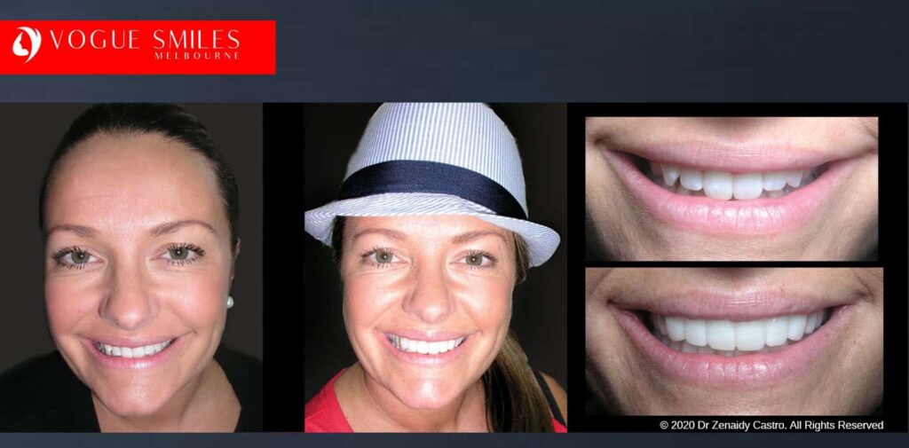 Most Affordable Way To Improve Your Smile in Melbourne CBD and Noble Park North - Snap on Smile Veneers | Removable Smile - Clip on Teeth -Cheapest Cosmetic Dentist in Dandenong North