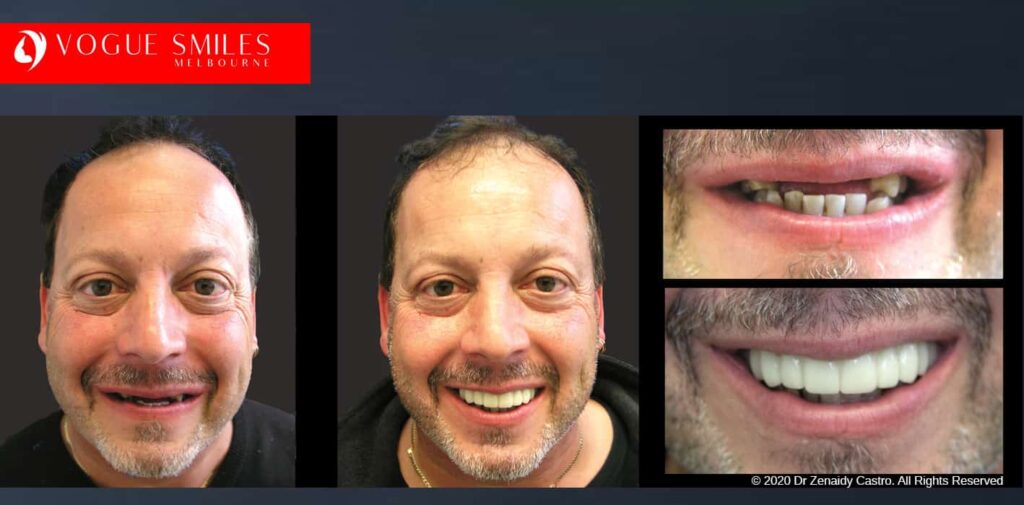 Most Affordable Way To Improve Your Smile in Melbourne CBD and Noble Park North - Snap on Smile Veneers | Removable Smile - Clip on Teeth -Cheapest Cosmetic Dentist in Dandenong North