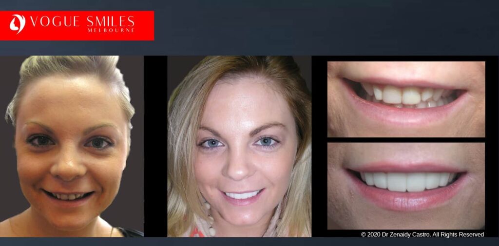 Most Affordable Way To Improve Your Smile in Melbourne CBD and Noble Park North - Snap on Smile Veneers | Removable Smile - Clip on Teeth -Cheapest Cosmetic Dentist in Dandenong North