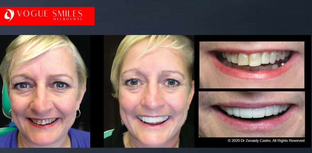 Most Affordable Way To Improve Your Smile in Melbourne CBD and Noble Park North - Snap on Smile Veneers | Removable Smile - Clip on Teeth -Cheapest Cosmetic Dentist in Dandenong North