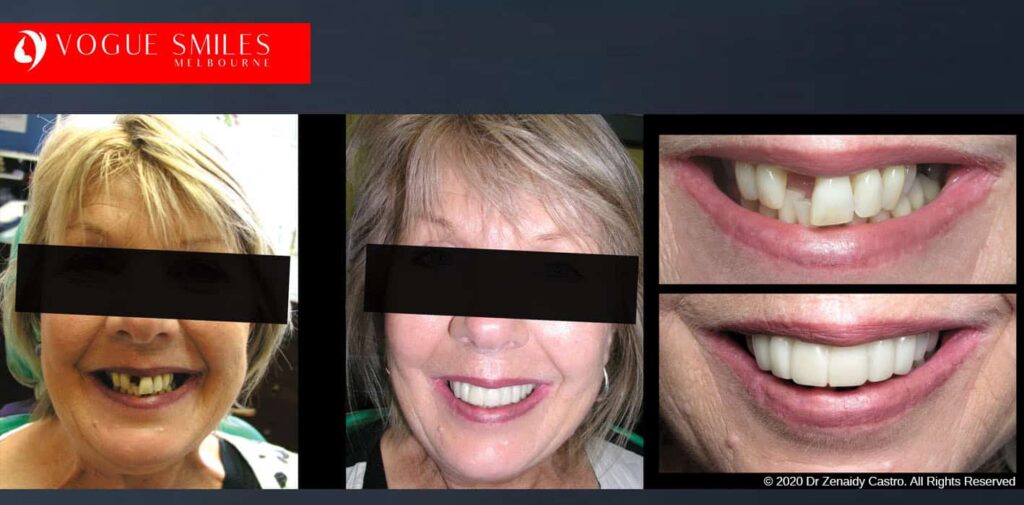 Most Affordable Way To Improve Your Smile in Melbourne CBD and Noble Park North - Snap on Smile Veneers | Removable Smile - Clip on Teeth -Cheapest Cosmetic Dentist in Dandenong North