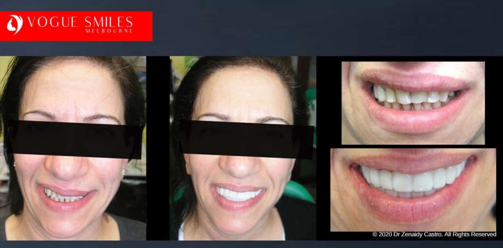 Most Affordable Way To Improve Your Smile in Melbourne CBD and Noble Park North - Snap on Smile Veneers | Removable Smile - Clip on Teeth -Cheapest Cosmetic Dentist in Dandenong North