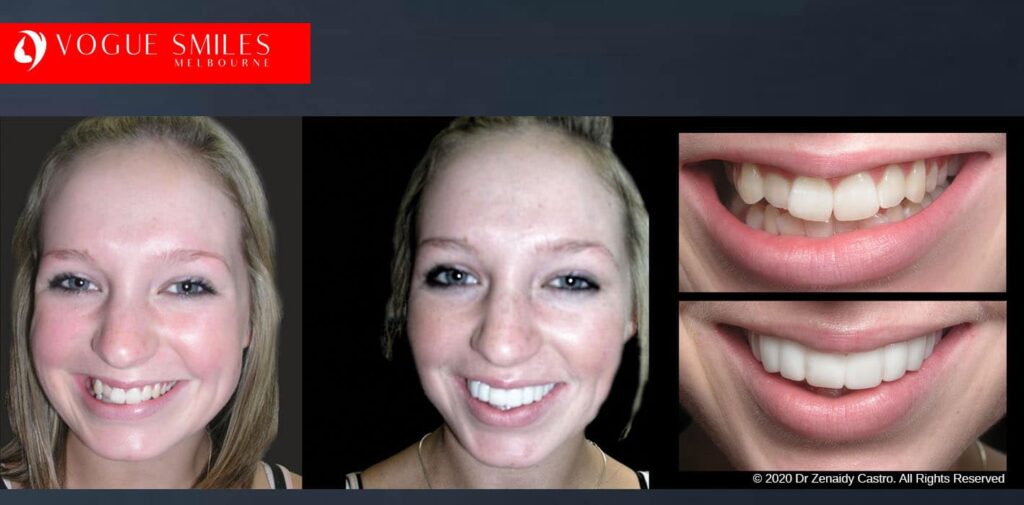 Most Affordable Way To Improve Your Smile in Melbourne CBD and Noble Park North - Snap on Smile Veneers | Removable Smile - Clip on Teeth -Cheapest Cosmetic Dentist in Dandenong North