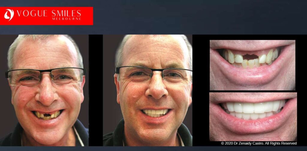 Most Affordable Way To Improve Your Smile in Melbourne CBD and Noble Park North - Snap on Smile Veneers | Removable Smile - Clip on Teeth -Cheapest Cosmetic Dentist in Dandenong North