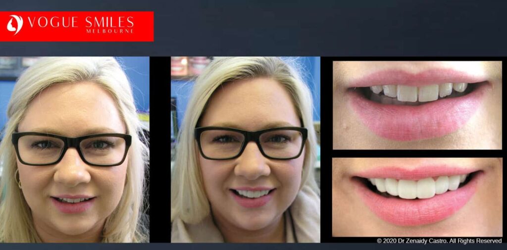 Most Affordable Way To Improve Your Smile in Melbourne CBD and Noble Park North - Snap on Smile Veneers | Removable Smile - Clip on Teeth -Cheapest Cosmetic Dentist in Dandenong North