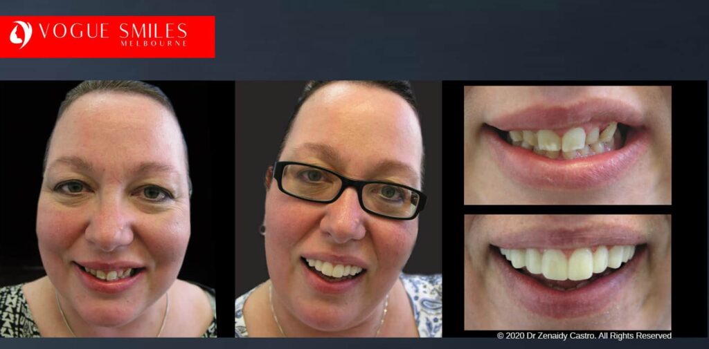 Most Affordable Way To Improve Your Smile in Melbourne CBD and Noble Park North - Snap on Smile Veneers | Removable Smile - Clip on Teeth -Cheapest Cosmetic Dentist in Dandenong North