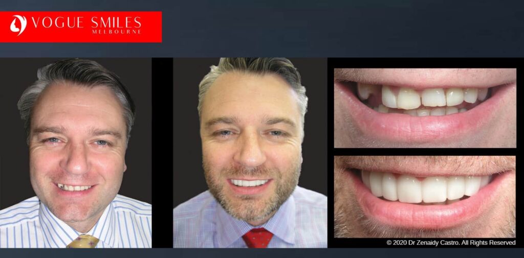 Most Affordable Way To Improve Your Smile in Melbourne CBD and Noble Park North - Snap on Smile Veneers | Removable Smile - Clip on Teeth -Cheapest Cosmetic Dentist in Dandenong North