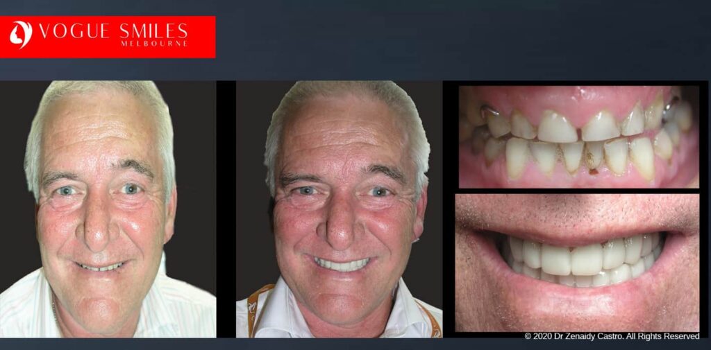 Most Affordable Way To Improve Your Smile in Melbourne CBD and Noble Park North - Snap on Smile Veneers | Removable Smile - Clip on Teeth -Cheapest Cosmetic Dentist in Dandenong North