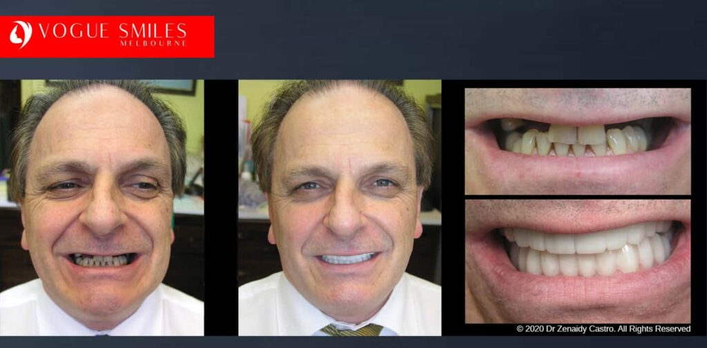 Most Affordable Way To Improve Your Smile in Melbourne CBD and Noble Park North - Snap on Smile Veneers | Removable Smile - Clip on Teeth -Cheapest Cosmetic Dentist in Dandenong North