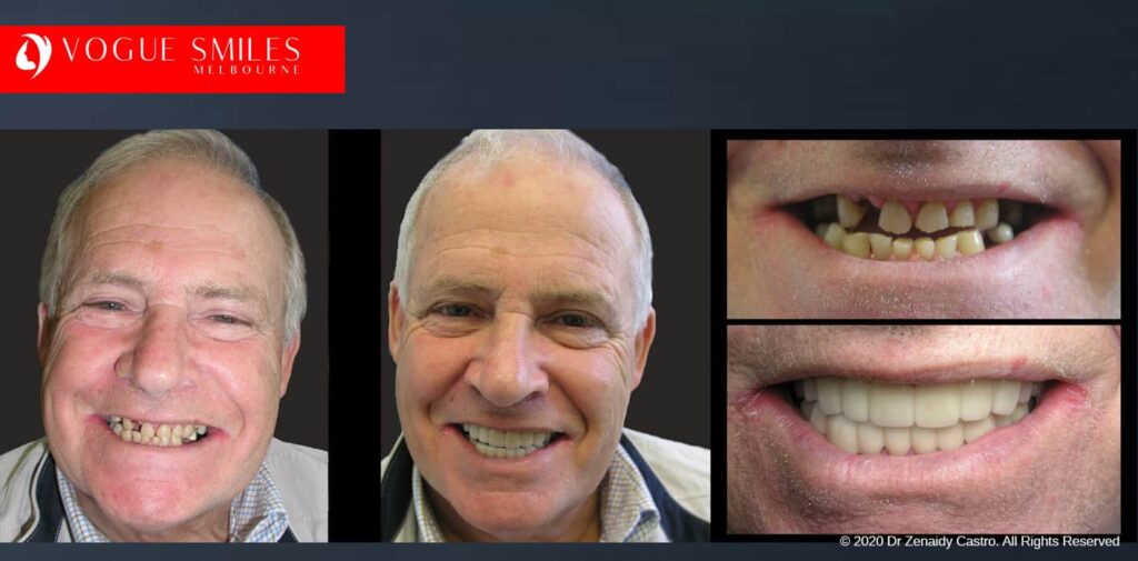 Most Affordable Way To Improve Your Smile in Melbourne CBD and Noble Park North - Snap on Smile Veneers | Removable Smile - Clip on Teeth -Cheapest Cosmetic Dentist in Dandenong North