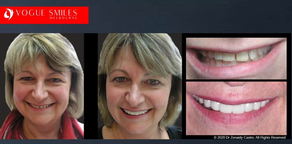Most Affordable Way To Improve Your Smile in Melbourne CBD and Noble Park North - Snap on Smile Veneers | Removable Smile - Clip on Teeth -Cheapest Cosmetic Dentist in Dandenong North