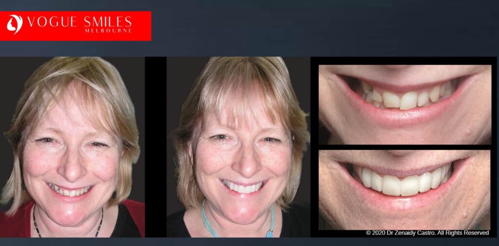 Most Affordable Way To Improve Your Smile in Melbourne CBD and Noble Park North - Snap on Smile Veneers | Removable Smile - Clip on Teeth -Cheapest Cosmetic Dentist in Dandenong North