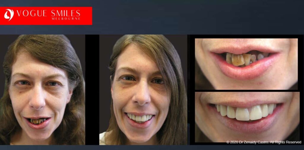 Most Affordable Way To Improve Your Smile in Melbourne CBD and Noble Park North - Snap on Smile Veneers | Removable Smile - Clip on Teeth -Cheapest Cosmetic Dentist in Dandenong North