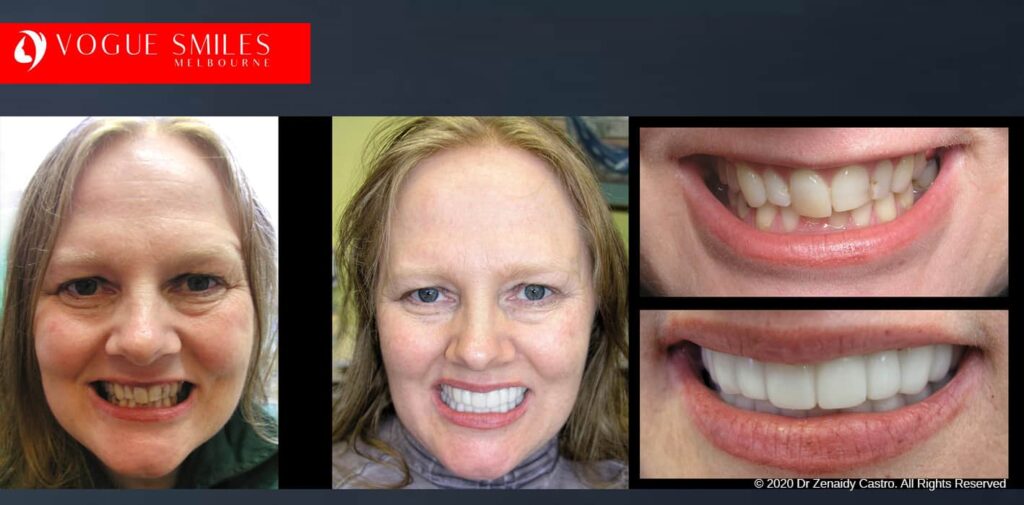 Most Affordable Way To Improve Your Smile in Melbourne CBD and Noble Park North - Snap on Smile Veneers | Removable Smile - Clip on Teeth -Cheapest Cosmetic Dentist in Dandenong North