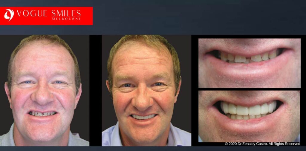 Most Affordable Way To Improve Your Smile in Melbourne CBD and Noble Park North - Snap on Smile Veneers | Removable Smile - Clip on Teeth -Cheapest Cosmetic Dentist in Dandenong North