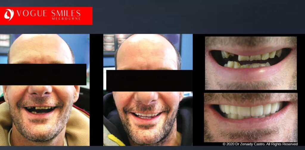 Most Affordable Way To Improve Your Smile in Melbourne CBD and Noble Park North - Snap on Smile Veneers | Removable Smile - Clip on Teeth -Cheapest Cosmetic Dentist in Dandenong North