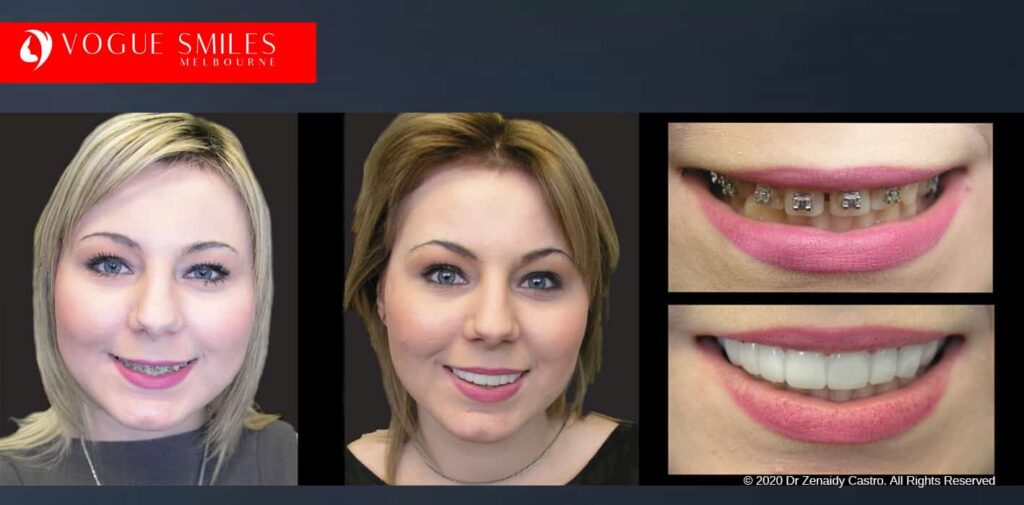 Most Affordable Way To Improve Your Smile in Melbourne CBD and Noble Park North - Snap on Smile Veneers | Removable Smile - Clip on Teeth -Cheapest Cosmetic Dentist in Dandenong North