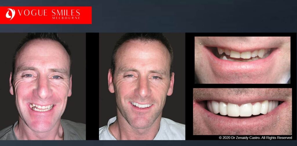 Most Affordable Way To Improve Your Smile in Melbourne CBD and Noble Park North - Snap on Smile Veneers | Removable Smile - Clip on Teeth -Cheapest Cosmetic Dentist in Dandenong North