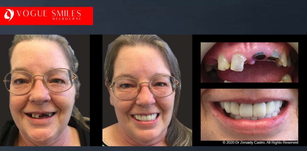 Most Affordable Way To Improve Your Smile in Melbourne CBD and Noble Park North - Snap on Smile Veneers | Removable Smile - Clip on Teeth -Cheapest Cosmetic Dentist in Dandenong North