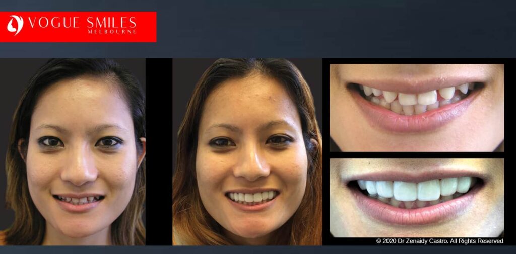 Most Affordable Way To Improve Your Smile in Melbourne CBD and Noble Park North - Snap on Smile Veneers | Removable Smile - Clip on Teeth -Cheapest Cosmetic Dentist in Dandenong North