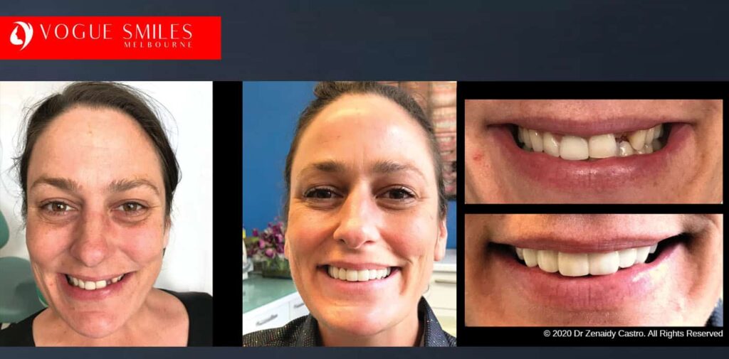 Most Affordable Way To Improve Your Smile in Melbourne CBD and Noble Park North - Snap on Smile Veneers | Removable Smile - Clip on Teeth -Cheapest Cosmetic Dentist in Dandenong North