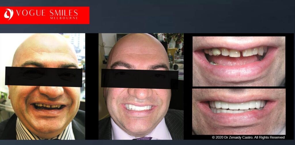 Most Affordable Way To Improve Your Smile in Melbourne CBD and Noble Park North - Snap on Smile Veneers | Removable Smile - Clip on Teeth -Cheapest Cosmetic Dentist in Dandenong North