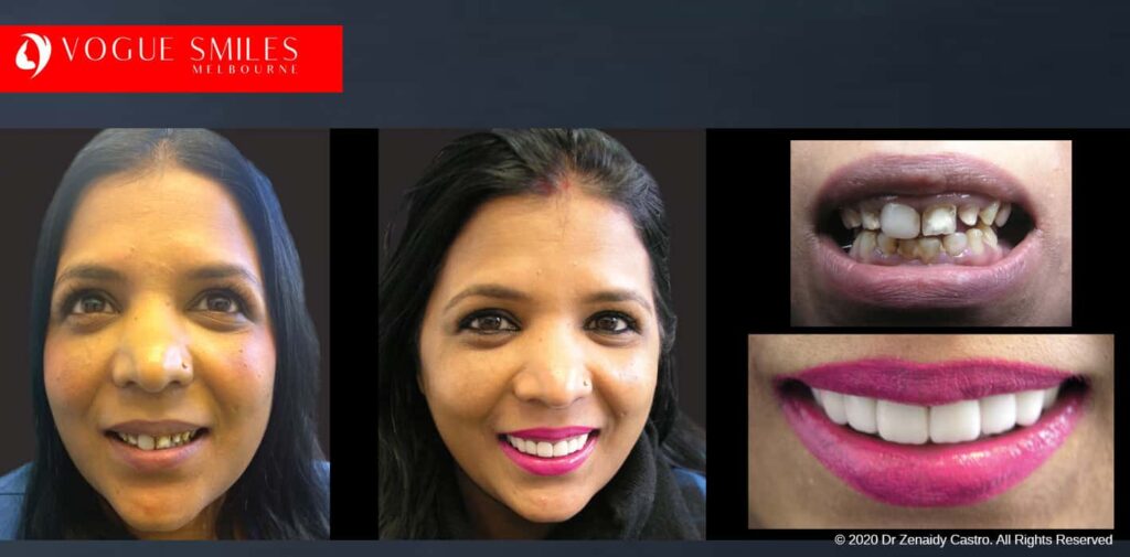 Most Affordable Way To Improve Your Smile in Melbourne CBD and Noble Park North - Snap on Smile Veneers | Removable Smile - Clip on Teeth -Cheapest Cosmetic Dentist in Dandenong North