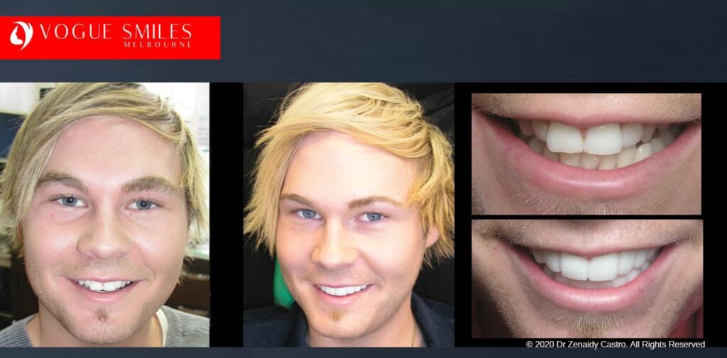 Most Affordable Way To Improve Your Smile in Melbourne CBD and Noble Park North - Snap on Smile Veneers | Removable Smile - Clip on Teeth -Cheapest Cosmetic Dentist in Dandenong North