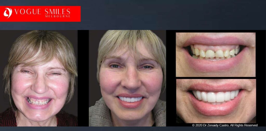 Most Affordable Way To Improve Your Smile in Melbourne CBD and Noble Park North - Snap on Smile Veneers | Removable Smile - Clip on Teeth -Cheapest Cosmetic Dentist in Dandenong North