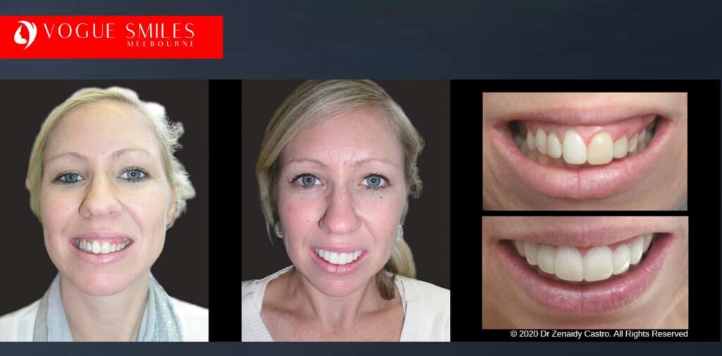 Most Affordable Way To Improve Your Smile in Melbourne CBD and Noble Park North - Snap on Smile Veneers | Removable Smile - Clip on Teeth -Cheapest Cosmetic Dentist in Dandenong North