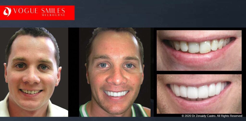 Most Affordable Way To Improve Your Smile in Melbourne CBD and Noble Park North - Snap on Smile Veneers | Removable Smile - Clip on Teeth -Cheapest Cosmetic Dentist in Dandenong North