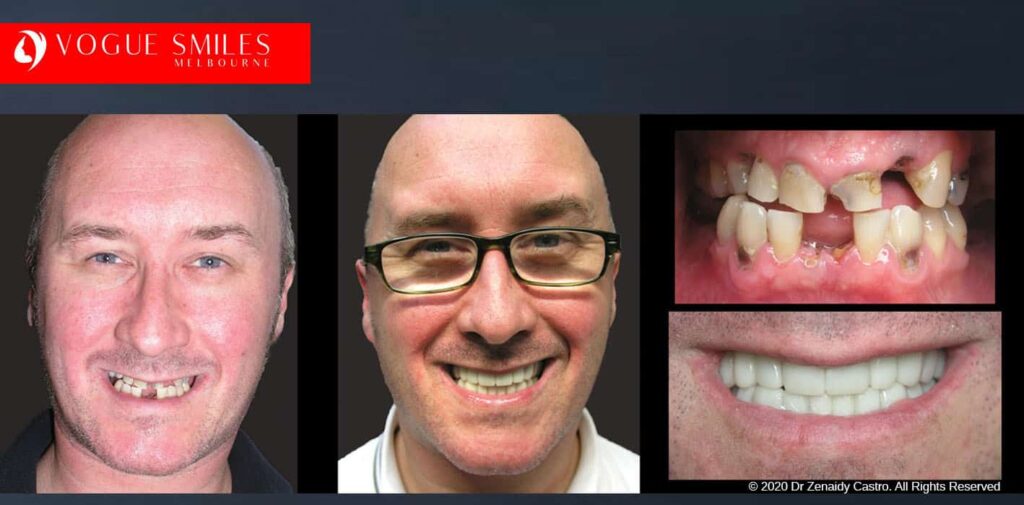 Most Affordable Way To Improve Your Smile in Melbourne CBD and Noble Park North - Snap on Smile Veneers | Removable Smile - Clip on Teeth -Cheapest Cosmetic Dentist in Dandenong North