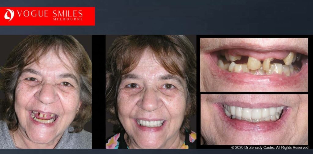 Most Affordable Way To Improve Your Smile in Melbourne CBD and Noble Park North - Snap on Smile Veneers | Removable Smile - Clip on Teeth -Cheapest Cosmetic Dentist in Dandenong North