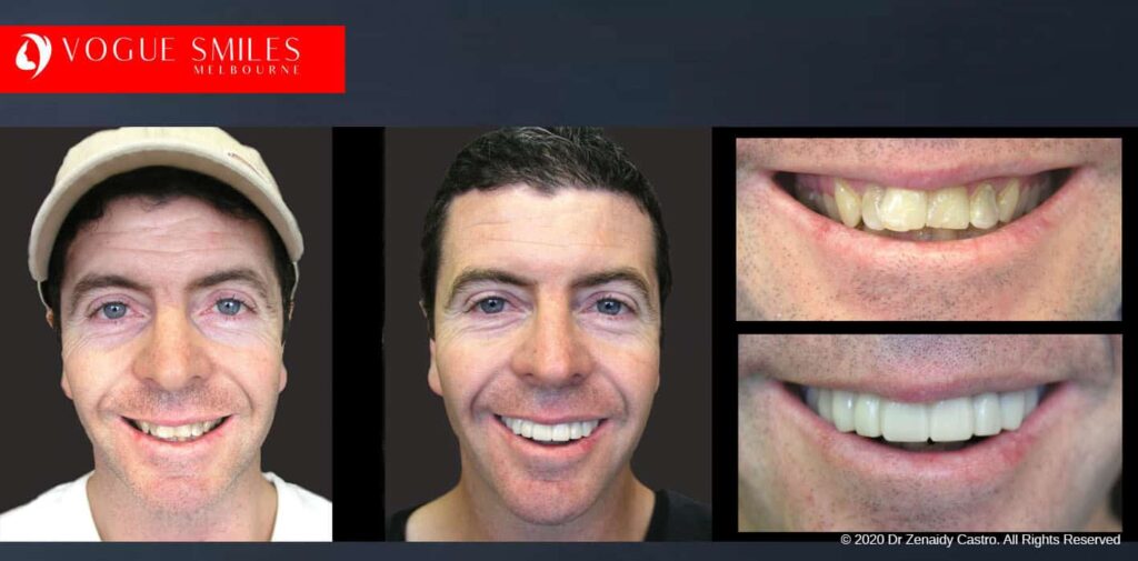 Most Affordable Way To Improve Your Smile in Melbourne CBD and Noble Park North - Snap on Smile Veneers | Removable Smile - Clip on Teeth -Cheapest Cosmetic Dentist in Dandenong North