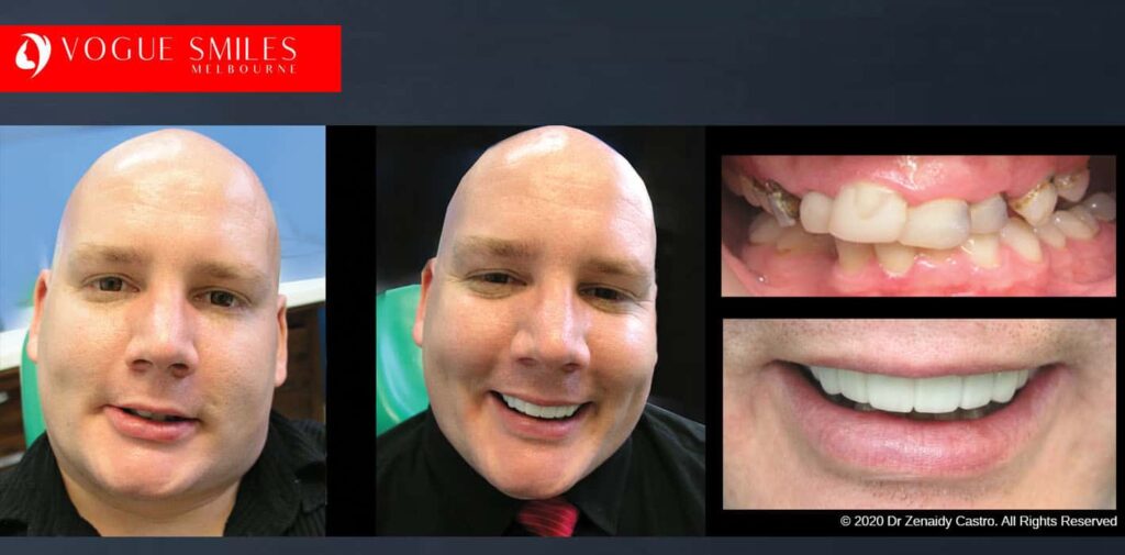 Most Affordable Way To Improve Your Smile in Melbourne CBD and Noble Park North - Snap on Smile Veneers | Removable Smile - Clip on Teeth -Cheapest Cosmetic Dentist in Dandenong North