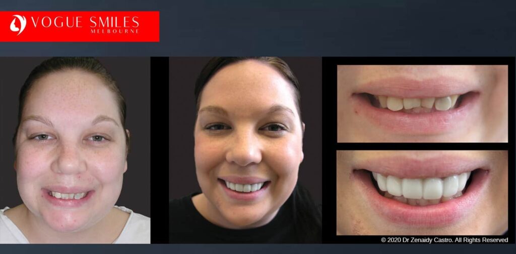 Most Affordable Way To Improve Your Smile in Melbourne CBD and Noble Park North - Snap on Smile Veneers | Removable Smile - Clip on Teeth -Cheapest Cosmetic Dentist in Dandenong North