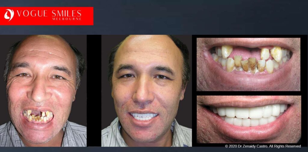 Most Affordable Way To Improve Your Smile in Melbourne CBD and Noble Park North - Snap on Smile Veneers | Removable Smile - Clip on Teeth -Cheapest Cosmetic Dentist in Dandenong North