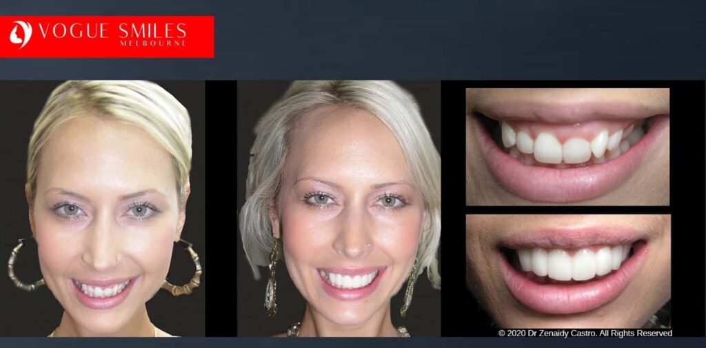 Most Affordable Way To Improve Your Smile in Melbourne CBD and Noble Park North - Snap on Smile Veneers | Removable Smile - Clip on Teeth -Cheapest Cosmetic Dentist in Dandenong North